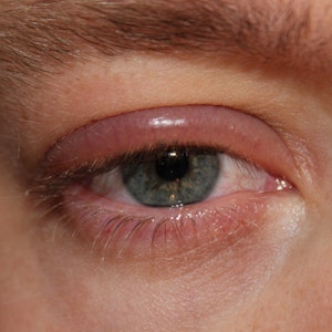 Close-up van een oog met opgezwollen oogranden