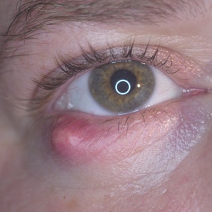 Close-up van een oog met een rode bobbel aan het onderooglid