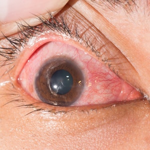 Close-up van een opengehouden oog met felle roodheid