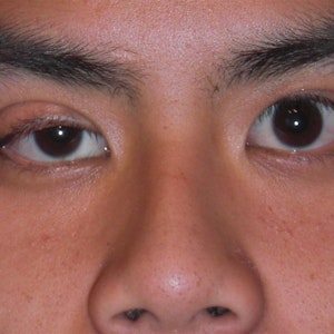 Close-up van een gezicht waarbij het bovenooglid aan een van de ogen lager hangt